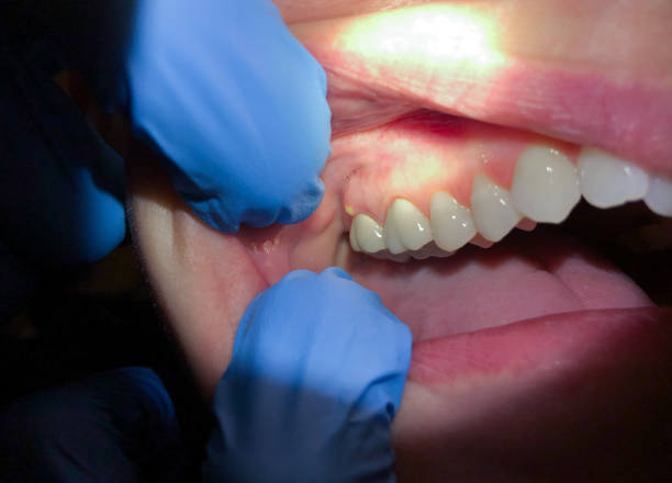 Best Emergency Dental Care for Broken or Chipped Teeth in Smiths Station, AL